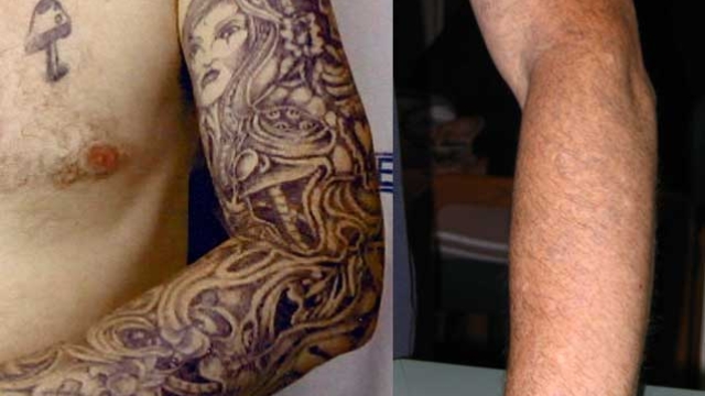 Gang Tattoo Removal – Very Essential