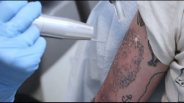 Tattoo Removal – Changing Your Mind Regarding Your Tattoo