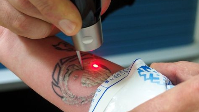 Bad Ink – Recognizing When It Is Time For Laser Tattoo Removal