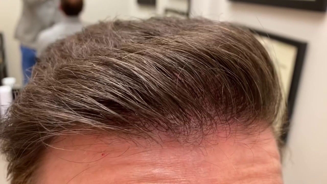 The Ultimate Guide to Transforming Your Look with a Hair Transplantation