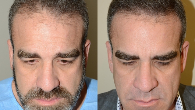 Top Secrets for a Gorgeous Hair Transplant Transformation!