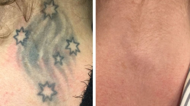 My Connection With Getting A Tattoo And It Removed