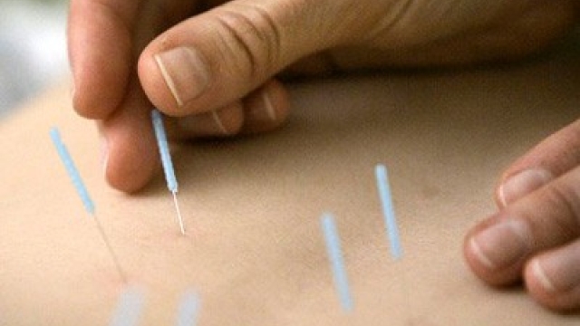 The Healing Power of Acupuncture: Unveiling the Ancient Art