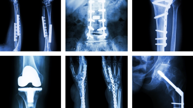 Unlocking the Secrets of Strong Bones: A Dive into Orthopedics