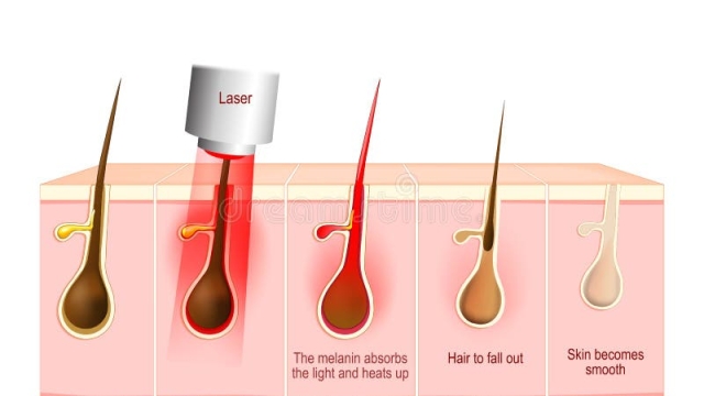 Smooth and Hair-Free: Unleashing the Magic of Laser Hair Removal